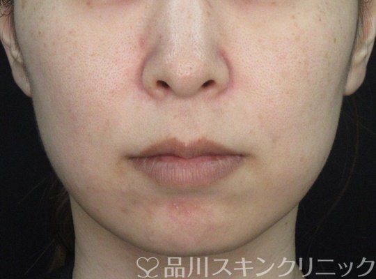 症例NO.70712のAFTER写真