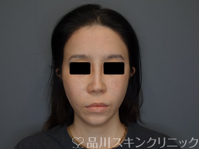 症例NO.75051のAFTER写真