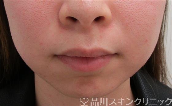 症例NO.34648のBEFORE写真