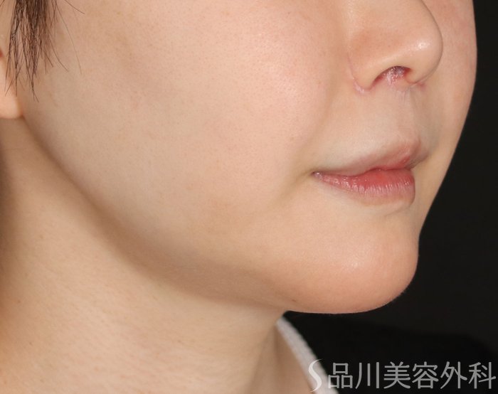 症例NO.73821のBEFORE写真
