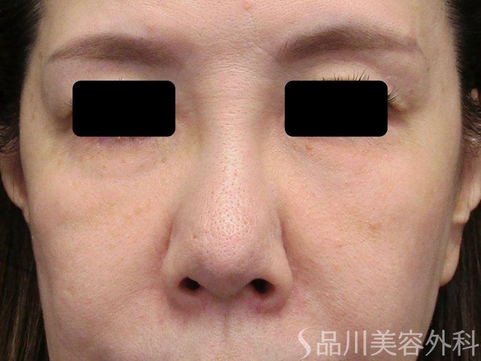 症例NO.75003のBEFORE写真