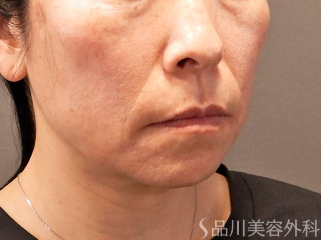症例NO.70858のBEFORE写真