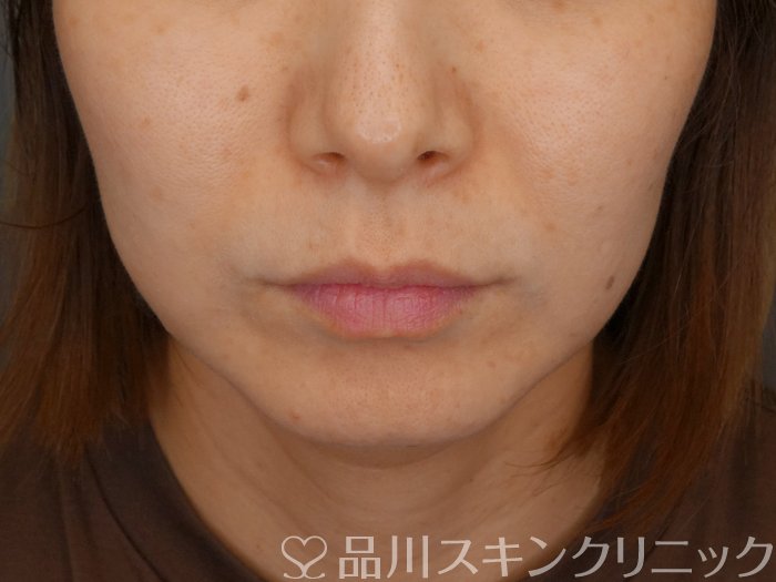 症例NO.70865のBEFORE写真