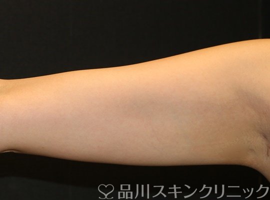 症例NO.71714のAFTER写真