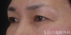 症例NO.74106のBEFORE写真