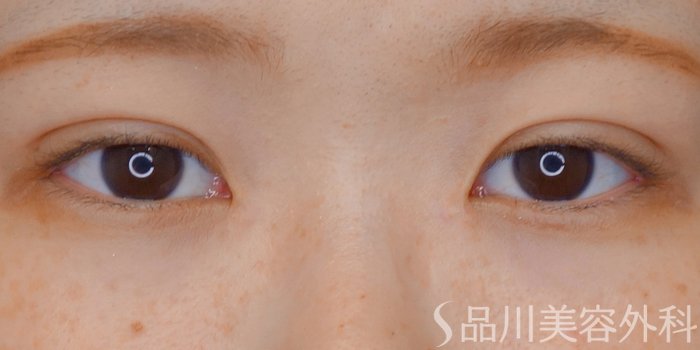 症例NO.70682のAFTER写真