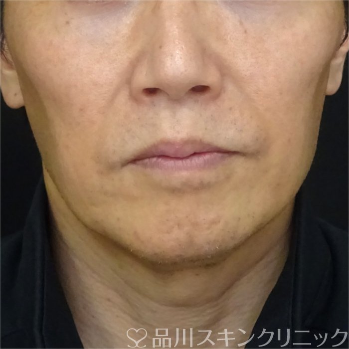 症例NO.72651のBEFORE写真