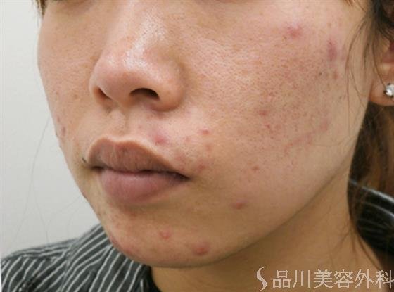 症例NO.31582のBEFORE写真