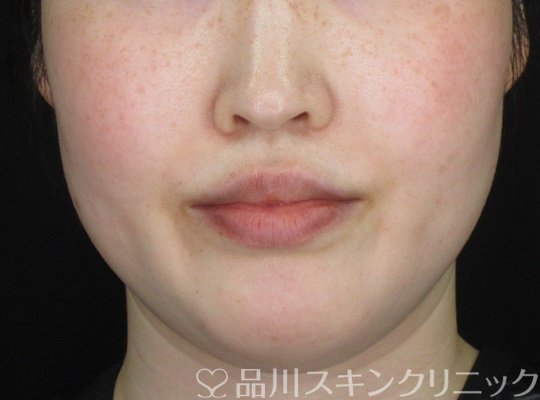症例NO.71060のBEFORE写真