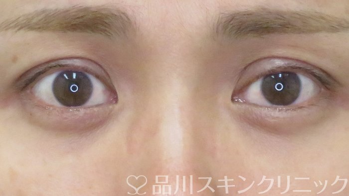 症例NO.71945のAFTER写真