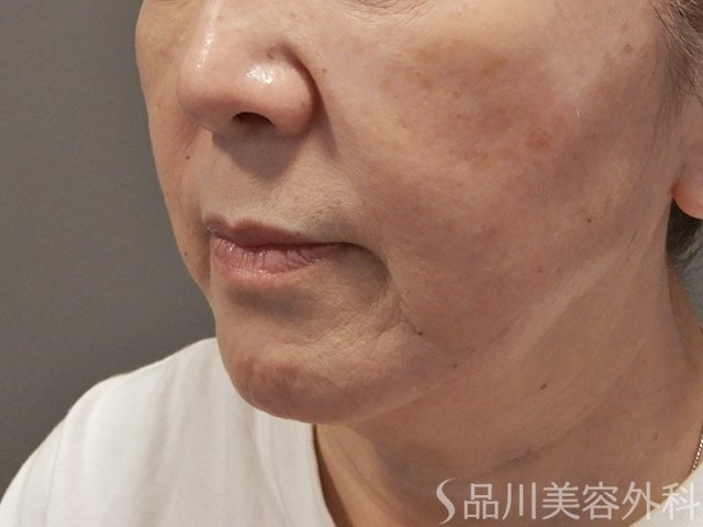 症例NO.73851のBEFORE写真