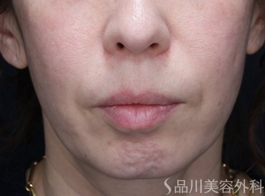 症例NO.73558のBEFORE写真