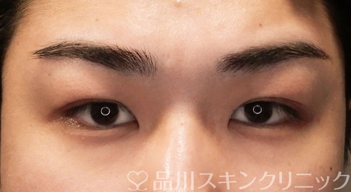 症例NO.70244のBEFORE写真