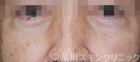 症例NO.64035のAFTER写真