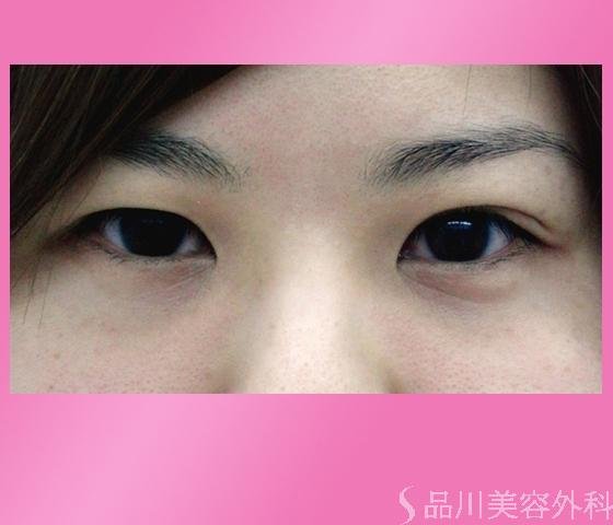 症例NO.1169のBEFORE写真