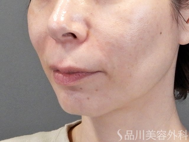 症例NO.69682のAFTER写真