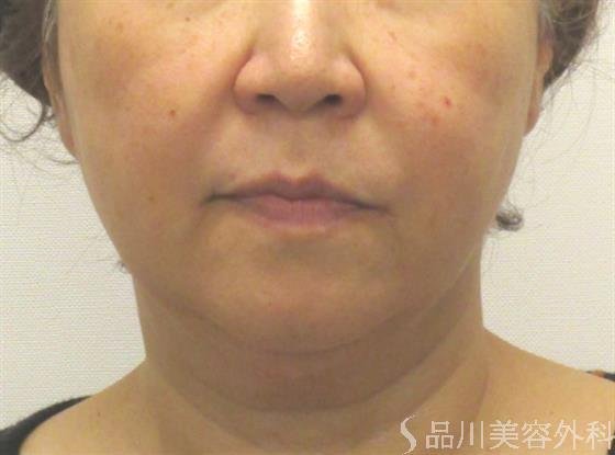 症例NO.45057のAFTER写真