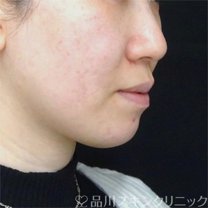 症例NO.69855のBEFORE写真