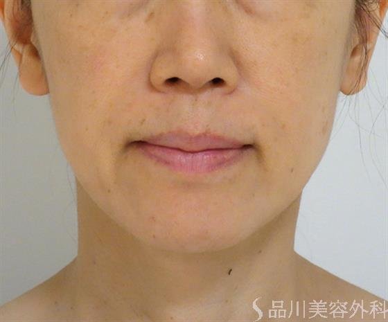 症例NO.44137のBEFORE写真