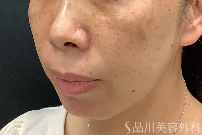 症例NO.67807のBEFORE写真
