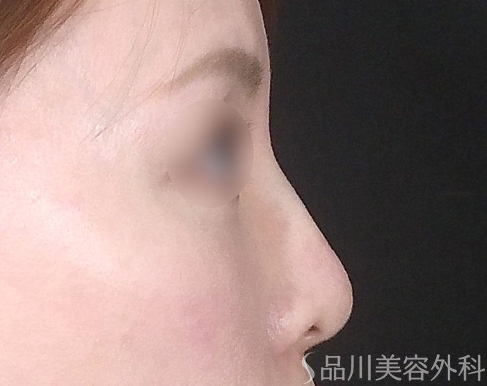 症例NO.67683のAFTER写真