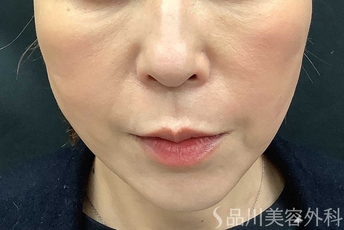 症例NO.62965のAFTER写真