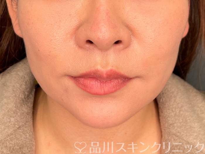 症例NO.73773のAFTER写真