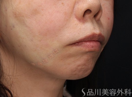 症例NO.72432のAFTER写真