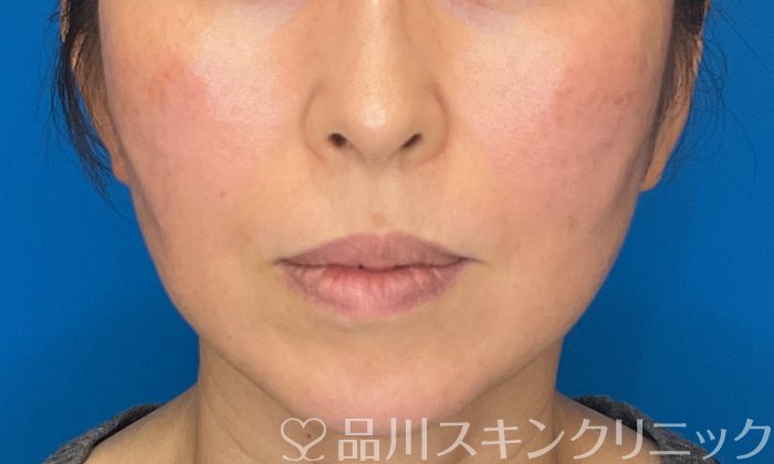 症例NO.74453のAFTER写真