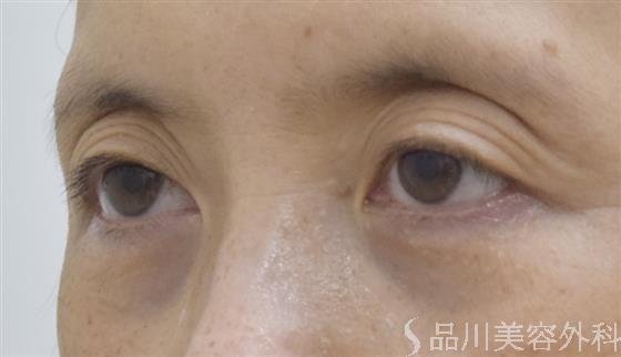 症例NO.52197のBEFORE写真