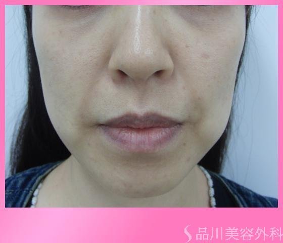 症例NO.2947のBEFORE写真