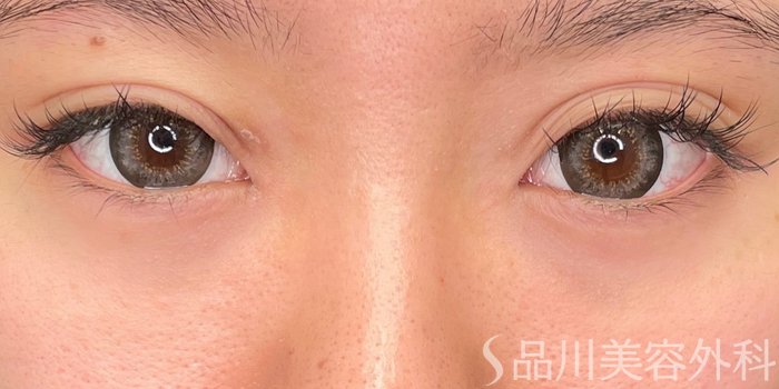 症例NO.65512のBEFORE写真