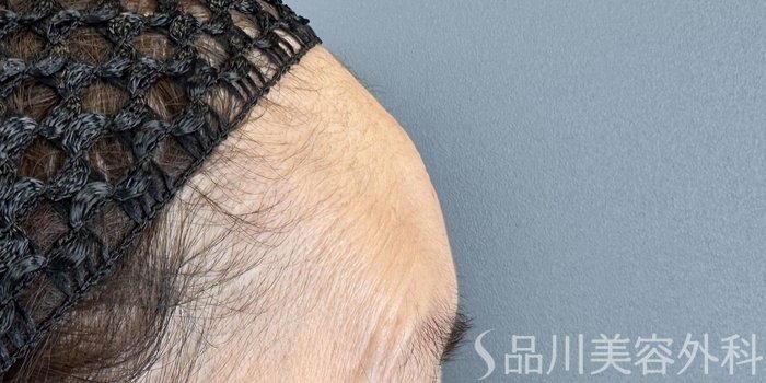 症例NO.65602のBEFORE写真