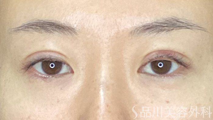 症例NO.74561のAFTER写真
