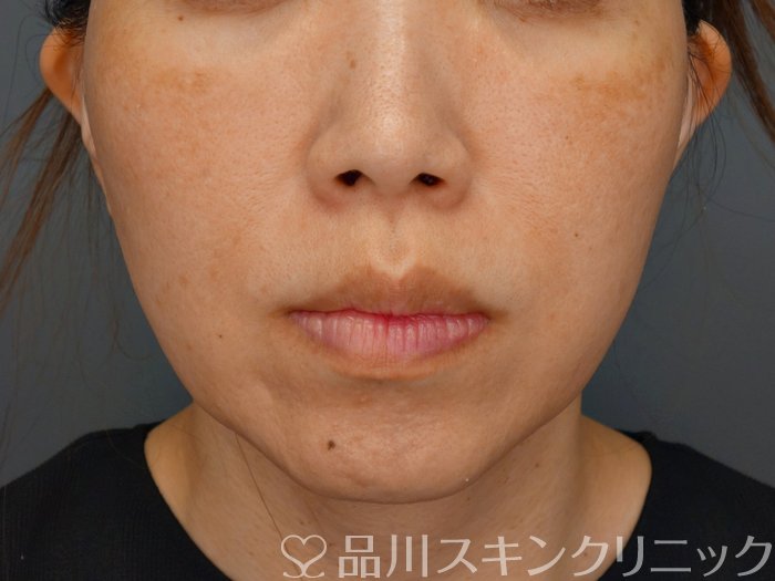症例NO.74005のBEFORE写真