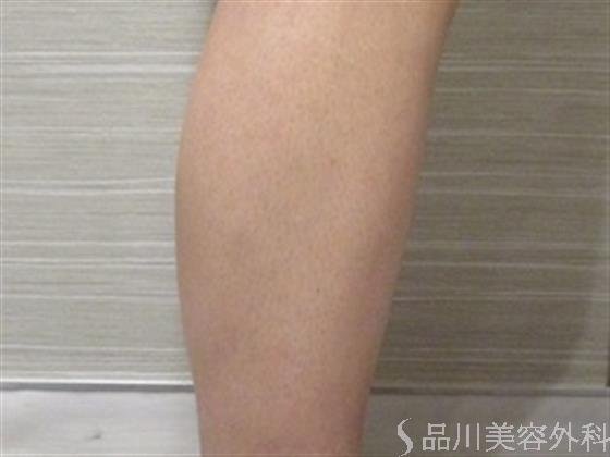 症例NO.36270のBEFORE写真