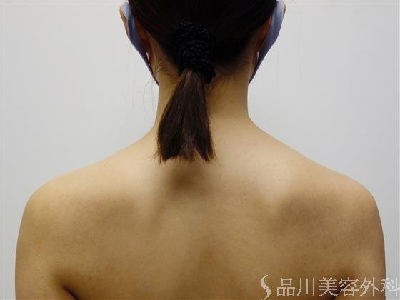 症例NO.50492のAFTER写真