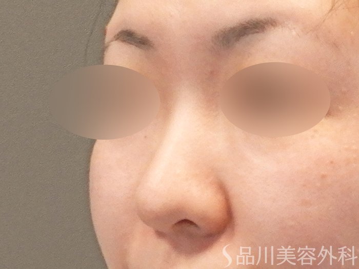 症例NO.64192のBEFORE写真