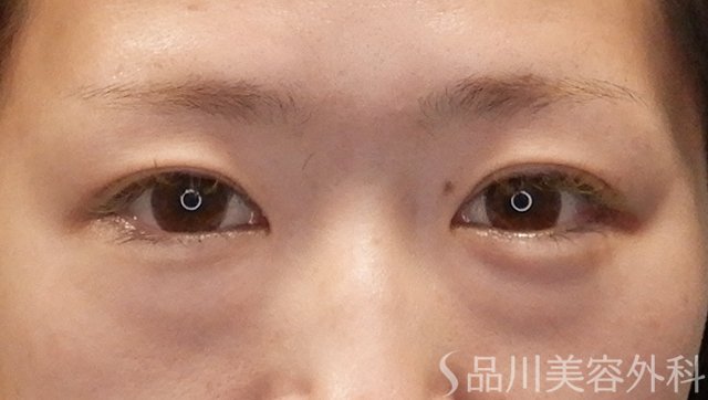 症例NO.73677のBEFORE写真