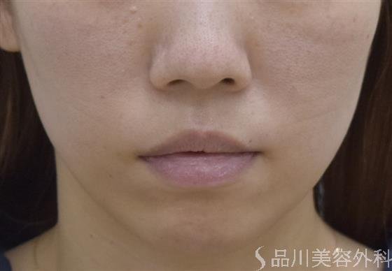 症例NO.47340のBEFORE写真