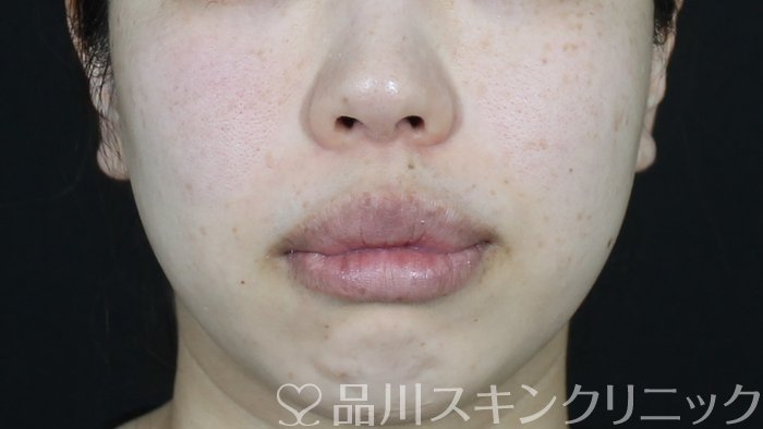 症例NO.71269のBEFORE写真