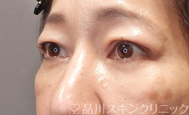 症例NO.68166のAFTER写真