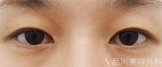 症例NO.31926のBEFORE写真