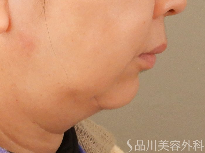 症例NO.70795のBEFORE写真