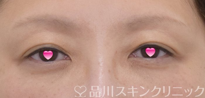 症例NO.74272のAFTER写真