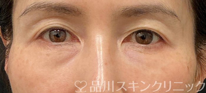 症例NO.74861のBEFORE写真