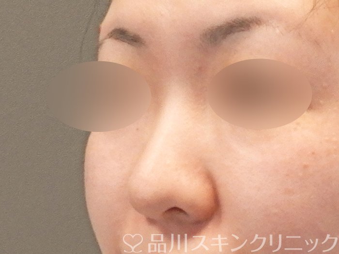 症例NO.64192のBEFORE写真
