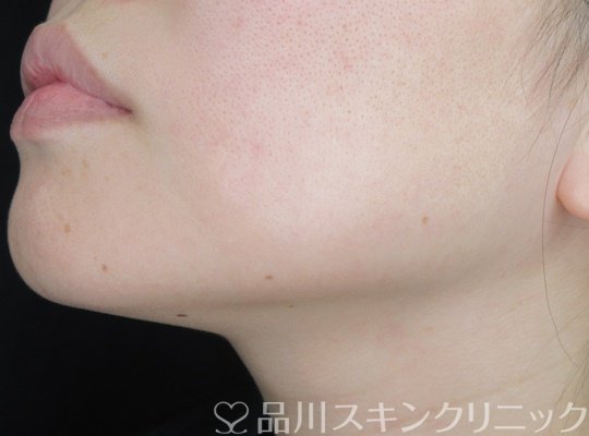 症例NO.70169のBEFORE写真
