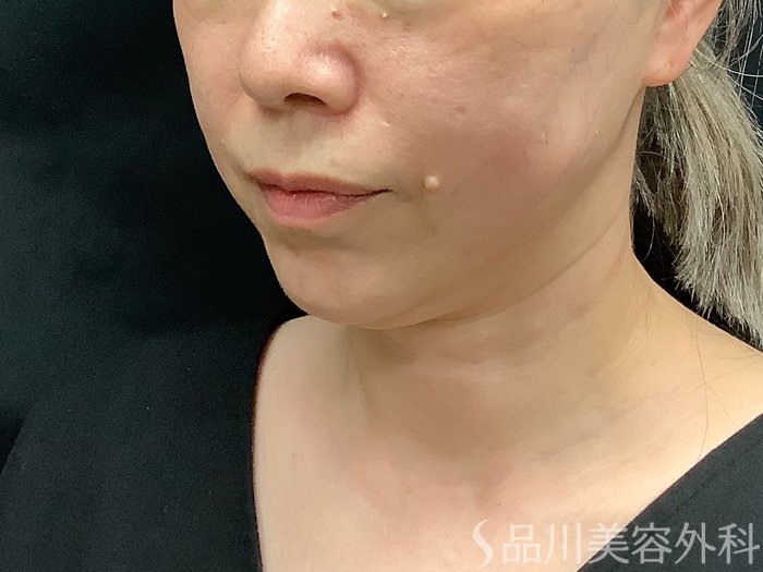 症例NO.75348のAFTER写真