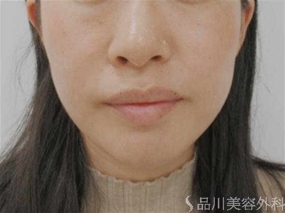 症例NO.51384のBEFORE写真